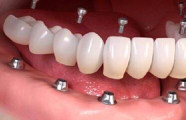 Bay Avenue Dental Centre, Orthodontist, Pediatric Dentist, Dental Implant Clinic Business Bay Dubai